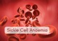 Sickle cell