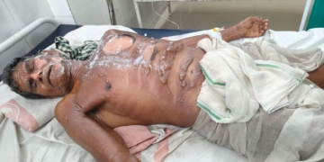 Boiling oil attack