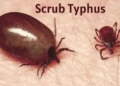 Scrub typhus cases Anugola