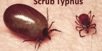 Scrub typhus cases Anugola