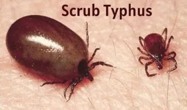 Scrub typhus cases Anugola